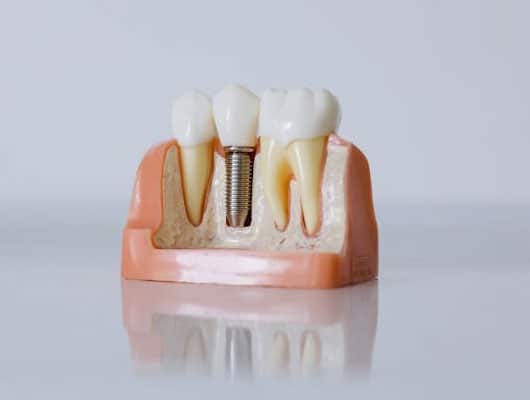 Dental Implants